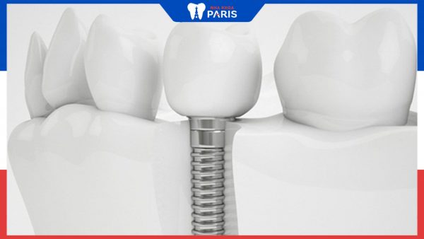 Báo giá trồng răng số 7 tại hệ thống Nha Khoa Paris