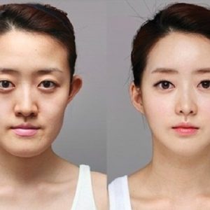 Gọt mặt bao lâu thì lành, các lưu ý khi chăm sóc