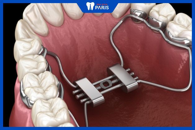 Nong hàm giúp tăng khoảng cách hàm răng hỗ trợ niềng