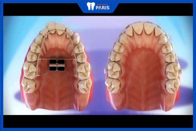 Nong hàm trước khi niềng răng giúp nâng cao hiệu quả chỉnh nha