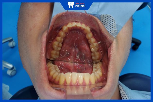 Nong hàm mất bao lâu tùy thuộc vào tình trạng răng mỗi người