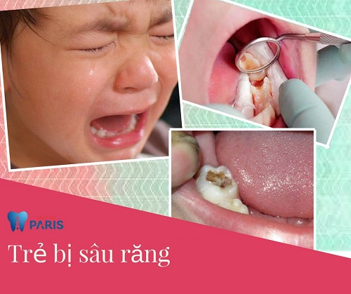 hình ảnh sâu răng ở trẻ em