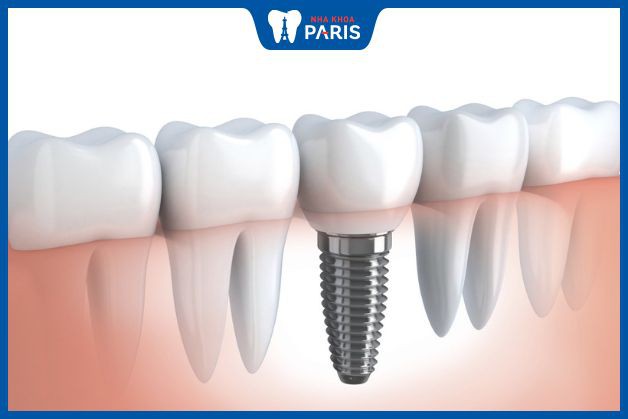 Implant có thể thay thế răng thật đến 99%