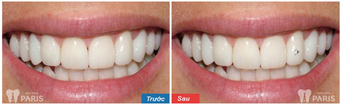 Cách đính đá vào răng bằng công nghệ E. Las răng Sáng ĐẸP nổi bật 4