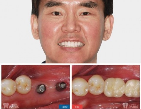 Khách hàng đánh giá về bác sĩ trồng răng Implant tại Đà Nẵng