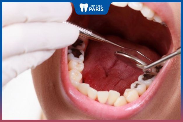 Khách hàng vẫn nên đến nha khoa để trị sâu răng hiệu quả