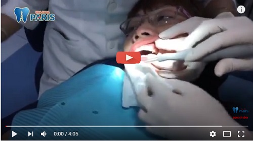 Video gắn đá vào răng tại nha khoa Paris