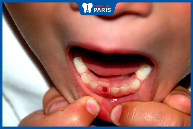 Trẻ bắt đầu thay răng vĩnh viễn từ 6 tuổi