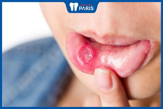 Lở miệng là gì? Thường xuyên bị lở loét miệng là bệnh gì?