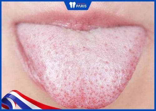 Bệnh lưỡi trắng là bệnh gì? Nguyên nhân và cách làm sạch lưỡi bị trắng