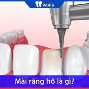 Mài răng hô là gì? chi phí mài răng hô giá bao nhiêu tiền