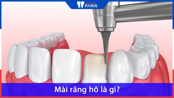 Mài răng hô là gì? chi phí mài răng hô giá bao nhiêu tiền