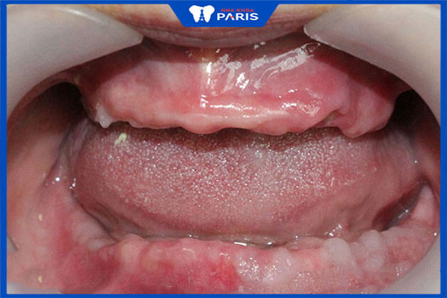 Nếu không thực hiện trồng răng nguyên hàm mất răng để lại nhiều hệ lụy