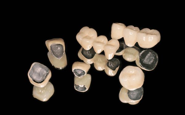 Nên bọc răng sứ kim loại hay titan?  Loại nào tốt hơn hẳn?