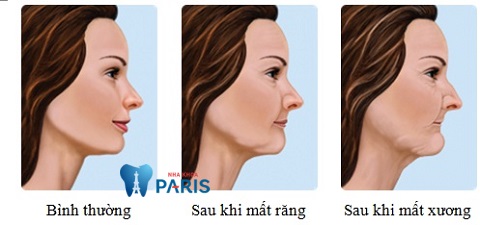 Không trồng lại răng sau khi nhổ làm ảnh hưởng tới tính thẩm mỹ khuôn mặt