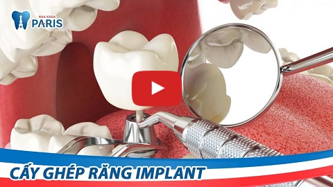 Video quy trình trồng răng bằng phương pháp Implant 4S tại Paris Dental Implant
