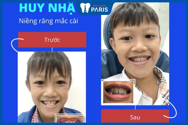 Niềng răng cho trẻ em ở đâu tốt?