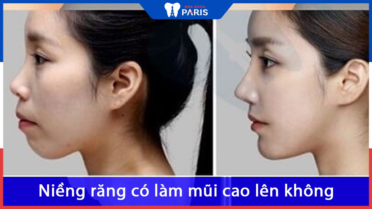 Niềng răng có làm mũi cao lên không? sức mạnh của niềng răng
