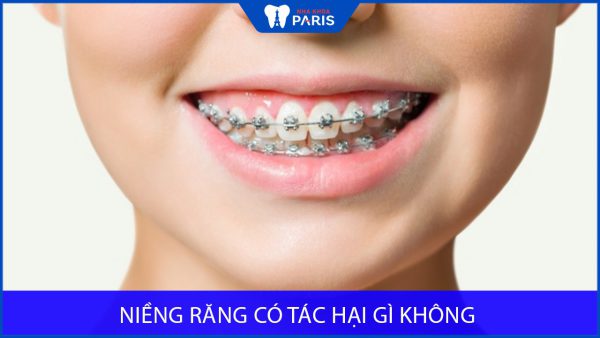 Niềng răng có tác hại gì không? Cách khắc phục