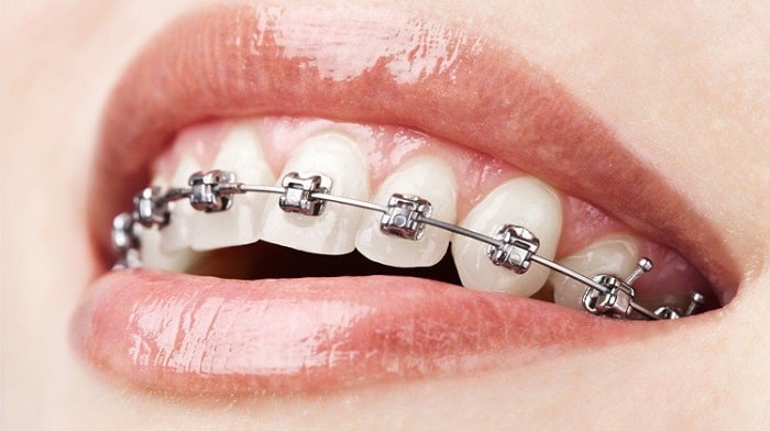 Khái niệm niềng răng mắc cài kim loại truyền thống