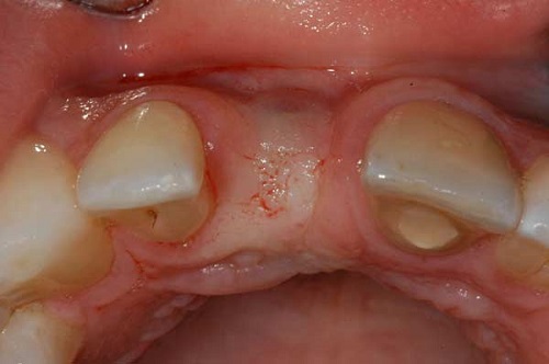 Niềng răng nhổ răng số 5 có đau không