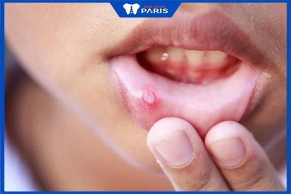 Nổi mụn nước trong khoang miệng: Nguyên nhân và cách điều trị