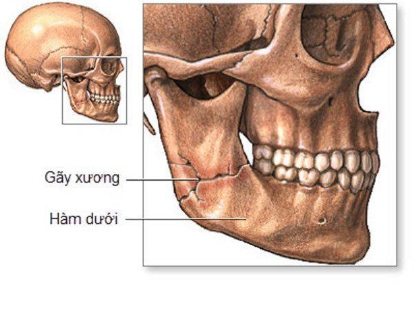 Gãy xương quai hàm: Phương pháp xử lý khi bị gãy xương quai hàm