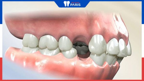 Phẫu thuật hàm hô nhổ răng số 4: Can thiệp tối thiểu, thẩm mỹ tối đa