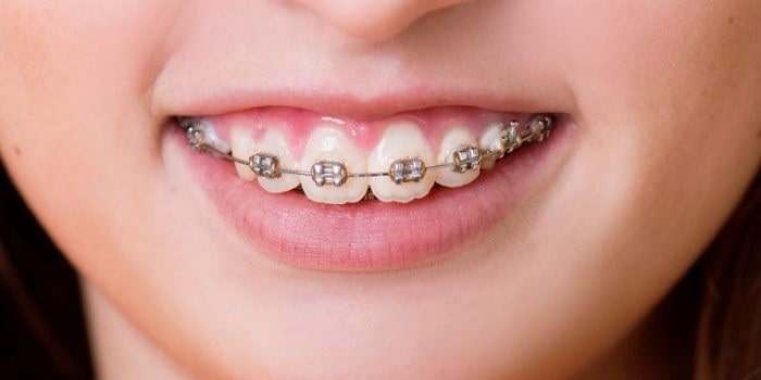 niềng răng chữa cười hở lợi hiệu quả hơn