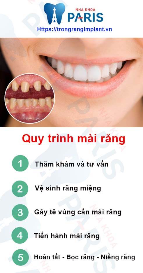 quy trình mài răng thẩm mỹ