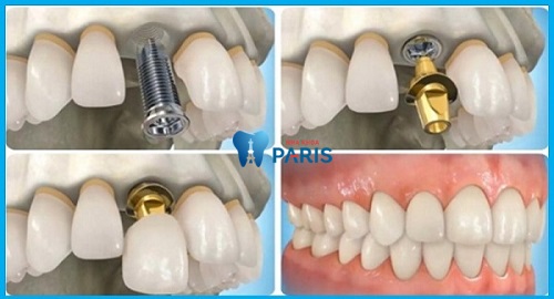 Trồng răng Implant là cách khắc phục răng 9630 trong trường hợp xấu nhất