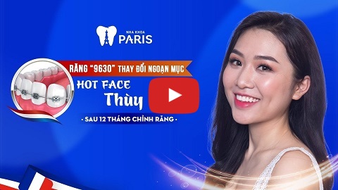 Video: “Răng 9630” - Thay đổi kinh ngạc sau 12 tháng Niềng răng - Hotface Thùy Linh