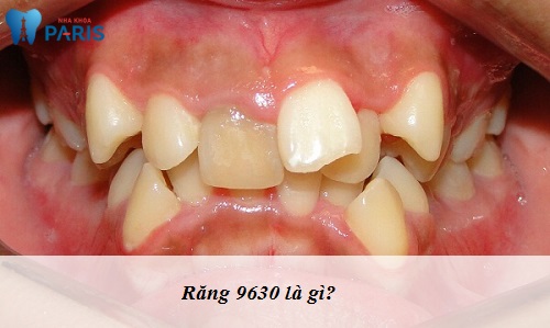 Răng 9630 ý chỉ tình trạng răng mọc lệch lạc, không đều