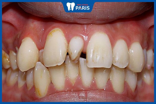 Bác sĩ cần đánh giá mức độ ảnh hưởng của răng lồi xỉ trước khi quyết định nhổ