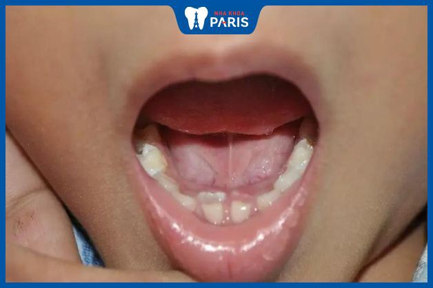 Có nhiều nguyên nhân khiến răng trẻ mọc lẫy