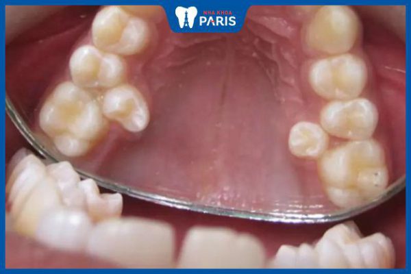 Tình trạng răng bị mọc lẫy ở trẻ | Xem cách xử lý