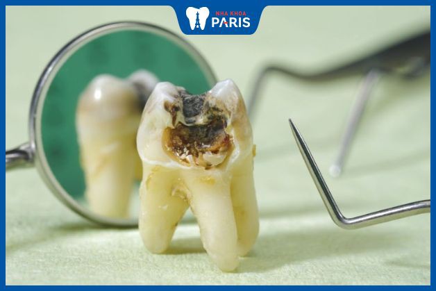 Răng sâu cần điều trị sớm
