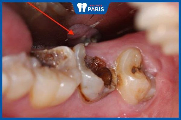 Răng bị sâu đen phải làm sao – Cách điều trị