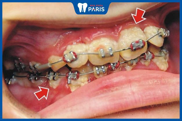 Cần điều trị răng sâu trước khi tiến hành niềng răng, chỉnh nha.