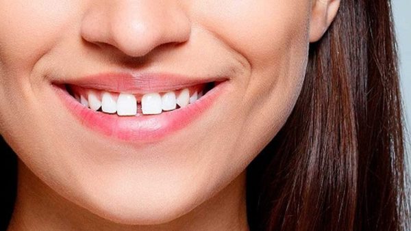 Răng cửa là răng nào? Cách khắc phục răng cửa thưa to