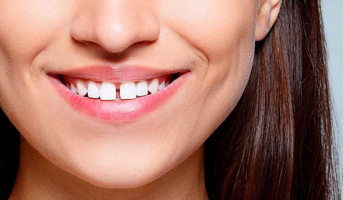 Không cần phải lo lắng về hình dáng của chiếc răng cửa xấu xí của bạn nữa. Với những phương pháp khắc phục hiệu quả, bạn sẽ có được hàm răng đẹp và toả sáng hơn bao giờ hết. Hãy xem hình ảnh để tìm hiểu thêm về phương pháp này.