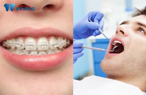 Răng đã điều trị tủy vẫn có thể niềng răng được.