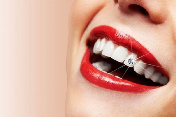 Răng gắn kim cương là gì