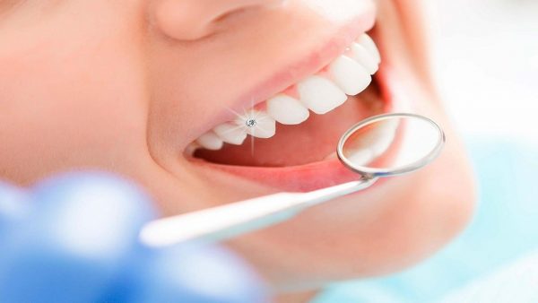 Răng gắn kim cương – Đẳng cấp mới cho hàm răng của bạn