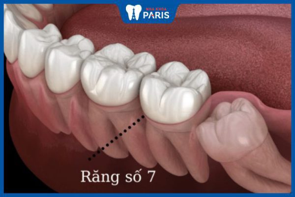 Răng hàm số 7 là răng nào? Hậu quả khi mất răng số 7