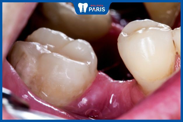 Nhổ răng số 7 lâu ngày có thể ảnh hưởng đến cấu trúc hàm