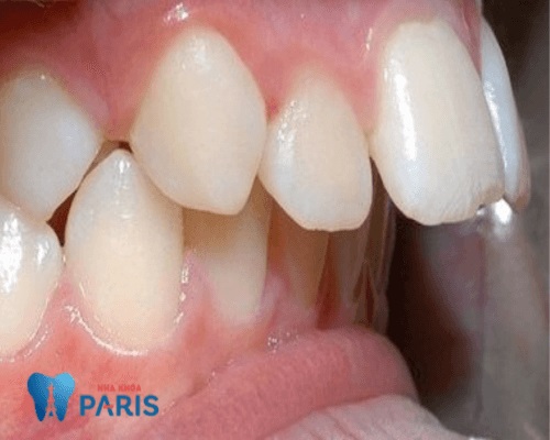 Răng vẩu/ Răng hô - khắc phục Bạn đang gặp vấn đề với răng vẩu hay răng hô khiến cho niềng răng trở nên khó khăn? Đừng lo lắng, chúng tôi cung cấp giải pháp khắc phục nhanh chóng và hiệu quả để giúp bạn có một hàm răng đẹp hoàn hảo.