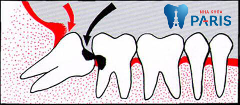 Răng khôn số 8 bị sâu có nguy cơ lây lan