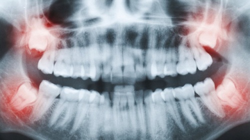 Răng khôn hàm trên mọc lệch ra má