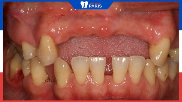 Hội chứng răng không mọc được Anodontia là gì? Khắc phục thế nào?